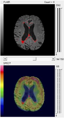 Prediction of Cognitive Decline from White Matter Hyperintensity and Single-Photon Emission Computed Tomography in Alzheimer’s Disease